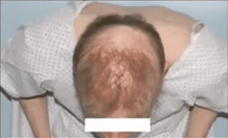 Pasadena, Los Angeles patient with an accumulation of hair transplant disasters right before his first hair repair surgery with Dr. U*