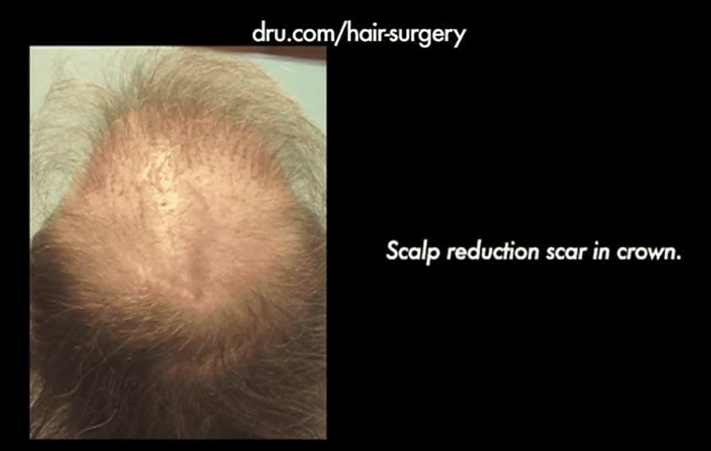 V-shaped scar remaining on top of the patient's head that resulted from a scalp reduction and failed hair restoration procedure.*