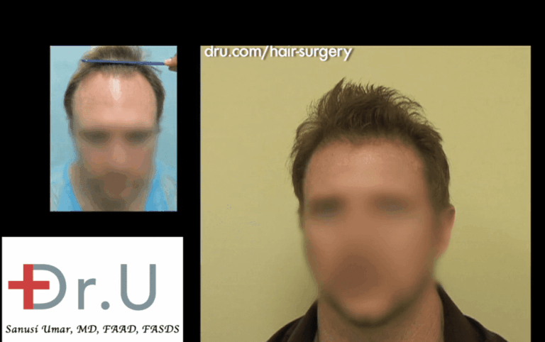 Receding Hairline Stage Transformed For Renewed Hairline