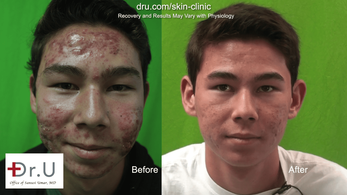 Wondering when to see a doctor for acne? If you’re suffering, don’t wait. Photodynamic acne treatment is a safe and effective method.