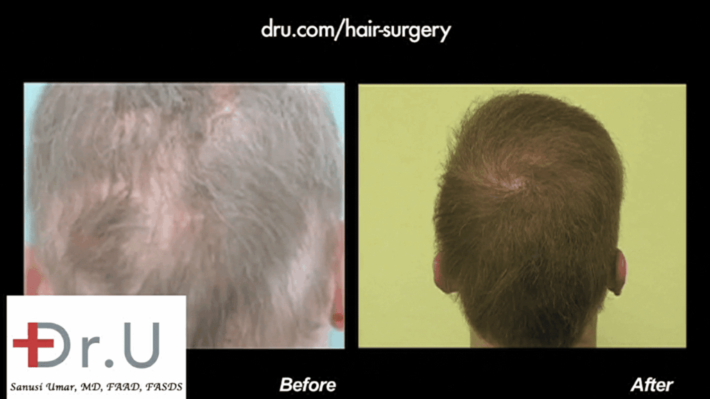 The back of the patient's head now has standard-looking coverage thanks to body hair grafts that were well inserted to recreate the typical growth patterns on the back of the head *