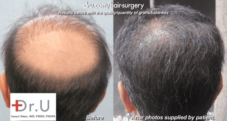 Body Hair Transplant To Fill In Bald Crown - Before and After
