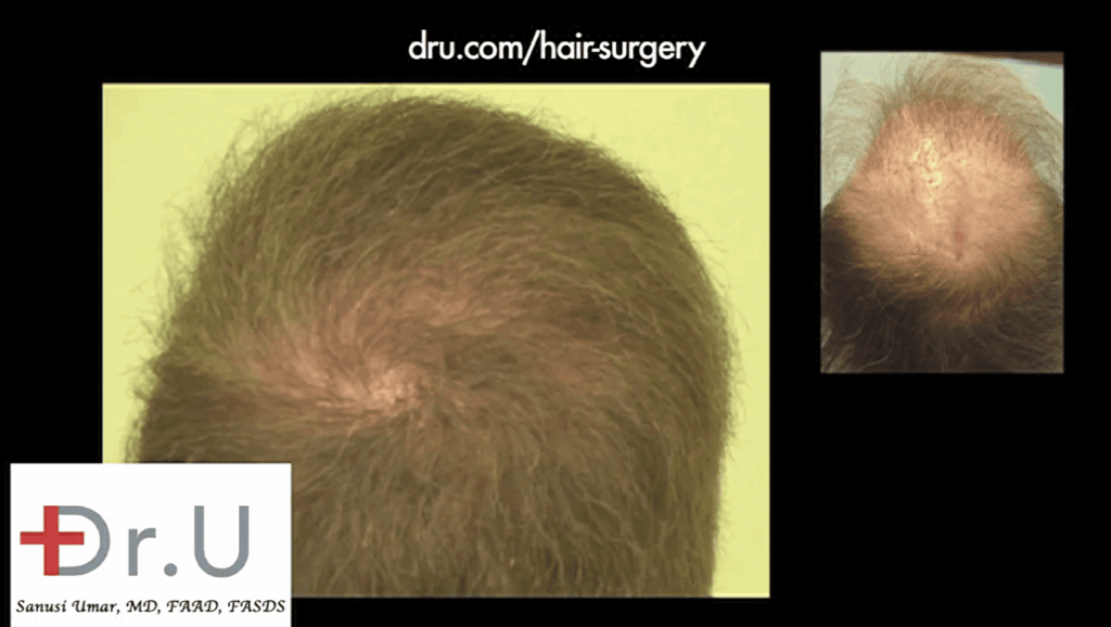 Close-up view of crown whorl and new coverage, which now masks the scalp reduction scar *
