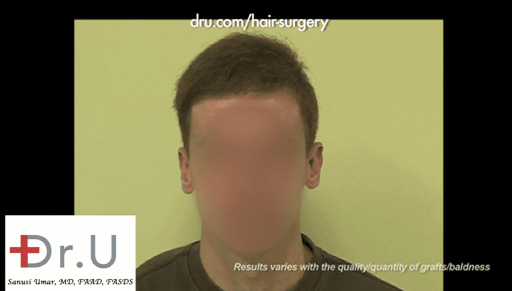Dr. Umar was indeed the best hair restoration repair doctor who succeeded in restoring an average-looking coverage *