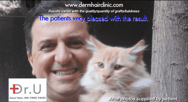 happy patient after hair transplant with 14,000 grafts