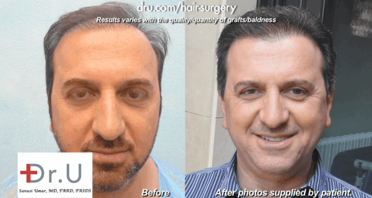 Patient's Hair Transplant With 14,000 Grafts - Before and After