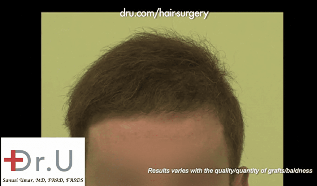 The patient's new hairline now lets him put his hair transplant disasters behind him *
