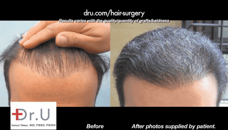 Body Hair Transplant Procedure to Fix Pluggy Hairline - Before and After Photos