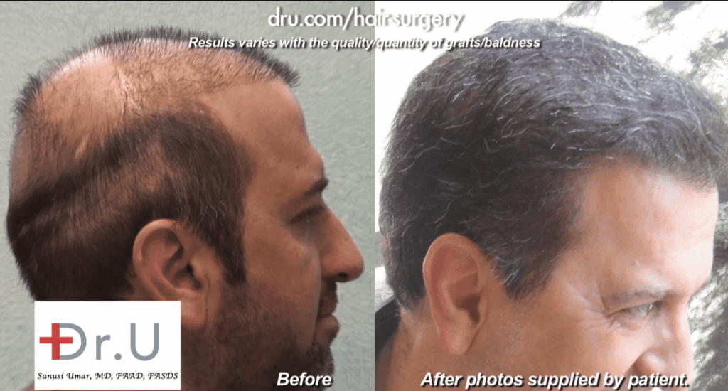 Dr.UGraft was able to reverse this patient's severe hair loss and damage from previous hair transplant work, creating the patient's desired appearance of coverage. Results shown 1 years after the procedure