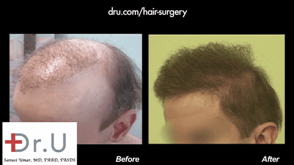 Dr.UGraft™ patient is now able to put the signs of failed hair restoration behind him with his excellent new coverage, which includes well-designed temples that frame his face in the best way possible *