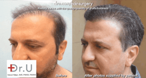 before and after surgery with Dr. U to repair a botched hair transplant outcome