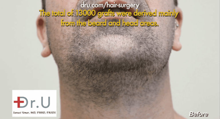 Patient's beard area before his surgery with Dr. Umar