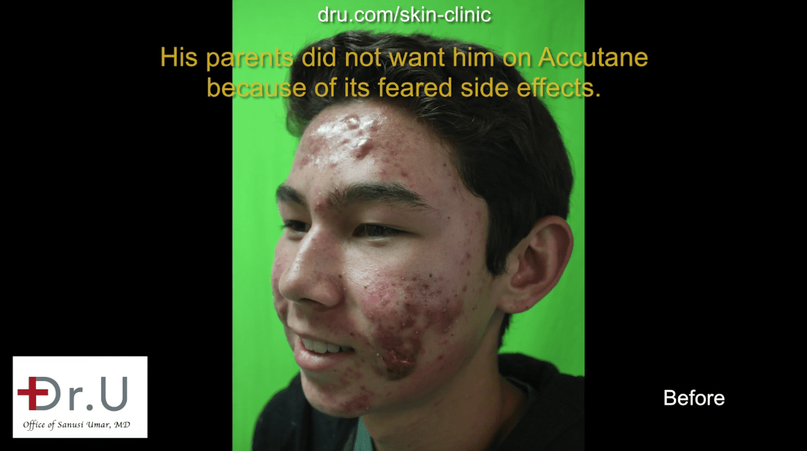 Photodynamic acne treatment is an alternative solution for acne that won’t go away.
