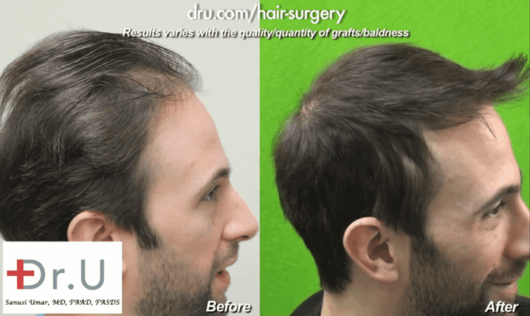 Hollywood, Los Angeles patient shown from the side before and after his celebrity hair restoration