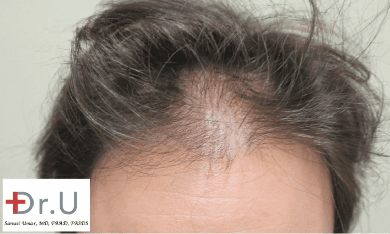 An FUE procedure at Dr. U's clinic was chosen to recreate a hairline and temples in celebrity