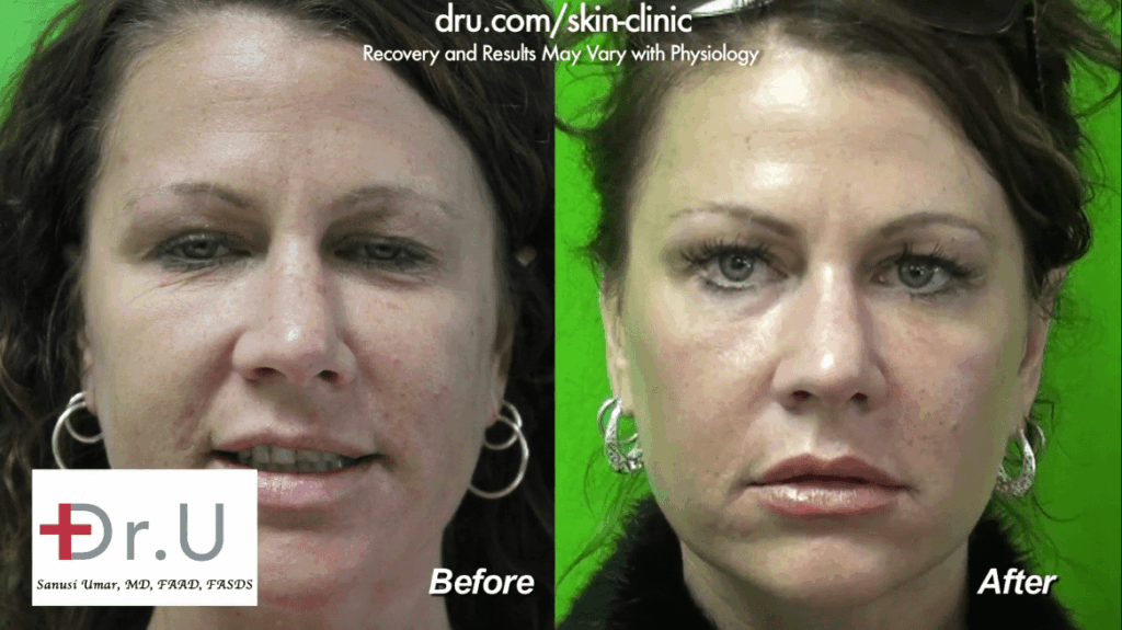 Redondo Beach, Los Angeles patient before and after Fraxel Dual Laser Treatment