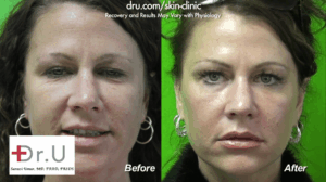 Redondo Beach, Los Angeles patient before and after Fraxel Dual Laser Treatment