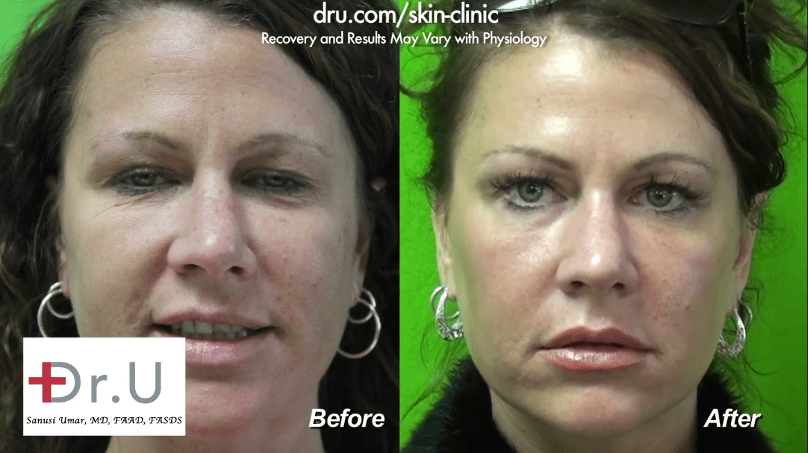 Fraxel laser for brown spots is also the solution for how to minimize pores and tighten skin.*