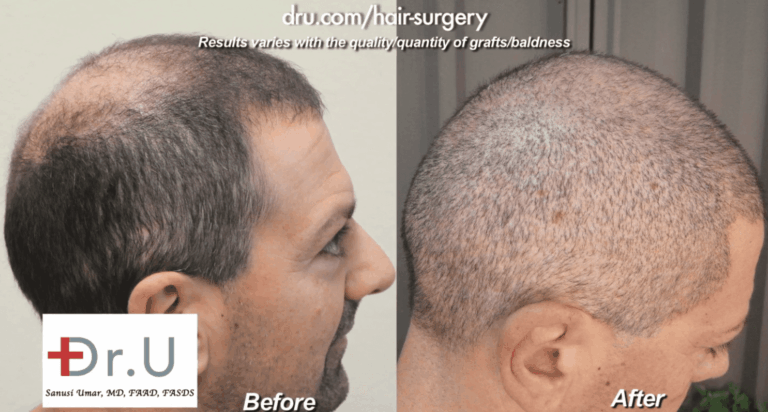 Beard and head hair grafts were used to conceal strip scars. Here are before and after photos