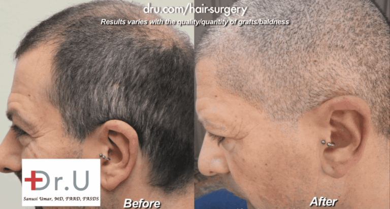 Beard and head hair grafts were used to conceal strip scars. Here are before and after photos
