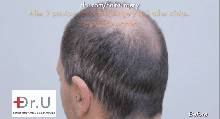 Sydney, Australia patient hopes to conceal strip scars through his body hair transplant with Dr. Umar