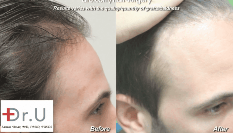 Dr. Umar was able to recreate hairline and temples in a celebrity 