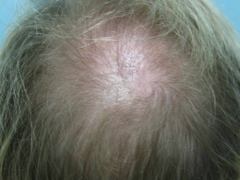 Newport Beach patient before his hair transplant for thinning crown