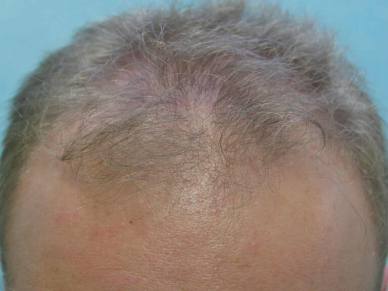 Dr. Umar's patient before his procedure to reverse hair thinning