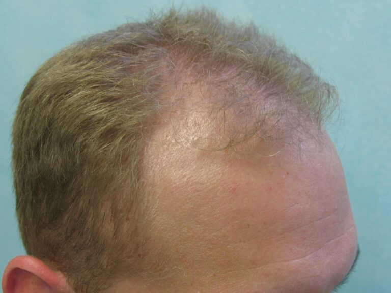 Hollywood, Los Angeles patient before FUE hairline reconstruction