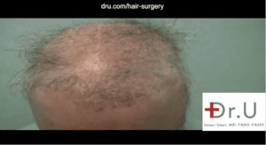 This patient required a body hair transplant for impossible repair due to the aftermath of procedures like flap surgery for hair restoration. 