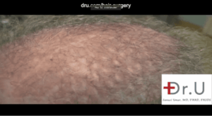 Manhattan Beach, Los Angeles patient shown before his Dr.UGraft procedure to repair punch graft hair restoration scars