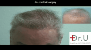 Dr. Umar used abdomen, beard and chest hair to repair a flap surgery hairline scar and achieve a natural-looking coverage for the top of this patient's head. 
