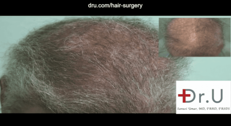 A body hair transplant for impossible repair is able to expand the donor supply, which is critical in cases like this when the head can no longer provide enough grafts. Body hair was used to achieve a normal looking coverage to adequately conceal the scars from past surgeries. 