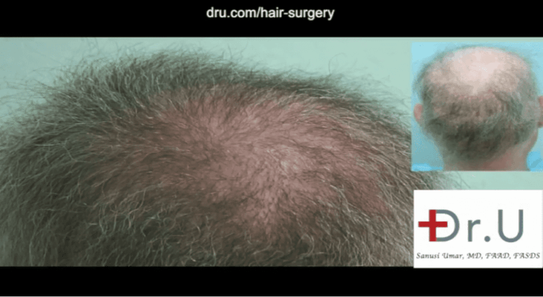 Body hair grafts were used to repair punch graft hair restoration scars and fill in the areas of failed growth from previous surgeries. 