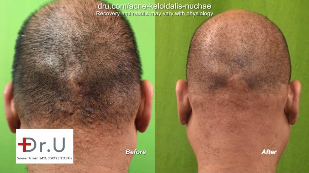 Laser Treatment used for AKN Patient*
