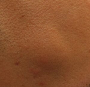 Benign cysts are harmless. But their appearance can still be distressing for patients, which is why many opt to have them removed. Los Angeles dermatologist Dr. Umar has years of experience in cyst removal for a normal cosmetic appearance. 