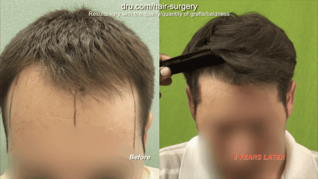 Dr. Umar runs a comb through the patient's hair 8 years after the patient's hairline restoration to show how the nape hair grafts survived long-term, while the patient continued to lose hair behind the transplanted area, showing that nape hair can be a permanent donor area. Nape hair allowed Dr. Umar extract how many grafts needed for hair transplant - 3,200 in total.