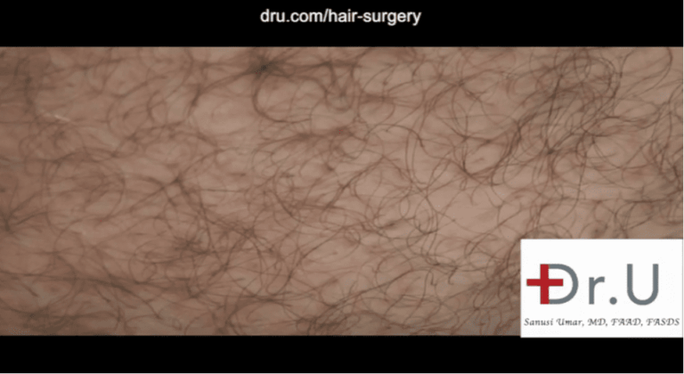 This patient's hair restoration with 10,000 grafts included graft taken from the abdomen. In this photo, a close-up view is shown six months after his surgery. This donor area shows no obvious signs of surgical extractions