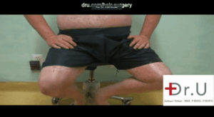 Manhattan Beach, Los Angeles patient was able to undergo a body hair transplant for impossible repair where hair was removed from his abdomen, chest, arms, thighs and beard. Here is a photo showing his donor areas in the lower areas of the body.