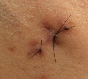 A surgical cyst removal will get rid of all troublesome tissue beneath the skin to prevent recurrence. As an experienced, double-certified dermatologist, Dr. Umar performs safe and efficient surgical cyst removal procedures in his Los Angeles skin clinic.
