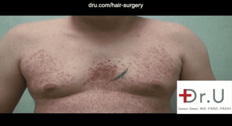 Patient on the last day of his body hair transplant surgery showing his chest after donor grafts were harvested