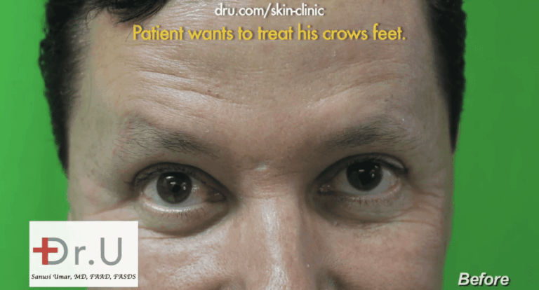 The patient wants to use a new Botox alternative to treat the deepened crow's feet lines around his eyes.*