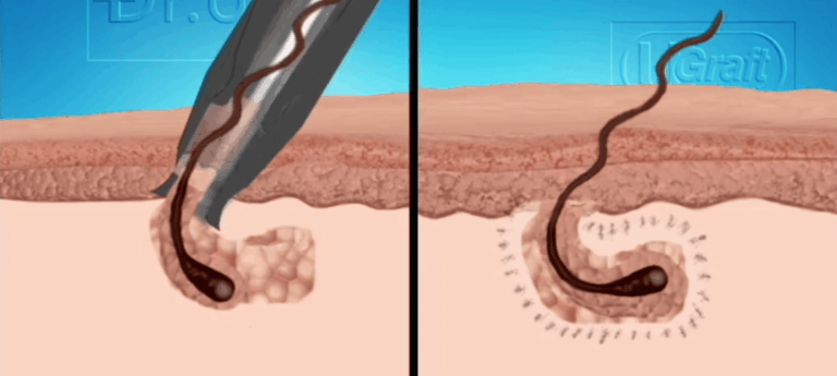 The Dr.UGraft rotary punch can be used on some black patients during a hair transplant procedure. But this application needs to be tested first