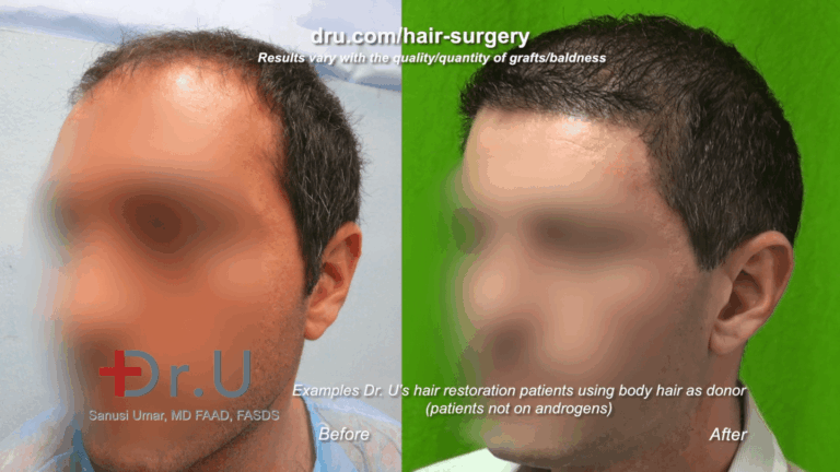 For Los Angeles patients who wonder, "does platelet rich plasma work for growing hair after a hair transplant," the answer is no. Results will depend on the surgeon's skill For Los Angeles patients who wonder, "does platelet rich plasma work for growing hair after a hair transplant," the answer is no. Results will depend on the surgeon's skill