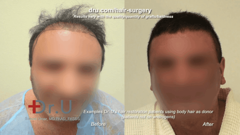 One way to circumvent the relation between testosterone and hair loss is through hair transplant. This patient received a 9,000 graft hair transplant, mostly using body and beard hair.*