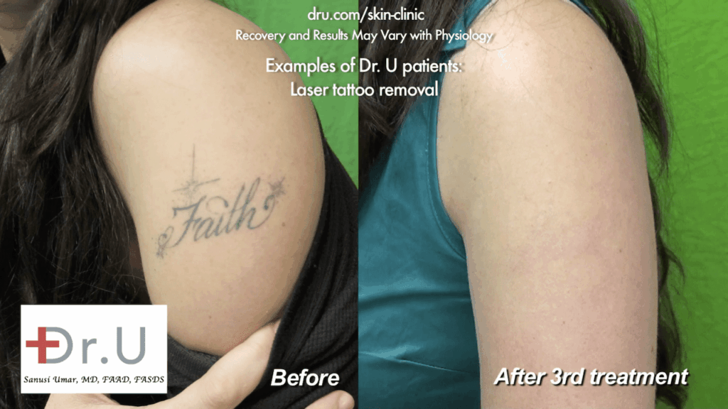 After three sessions of tattoo laser removal with Dr. Umar in Los Angeles, the patient happily shows off her ink-less arm.