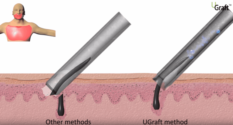 The DrUPunch i™ helps the operator navigate any deviations in follicle path beneath the skin.