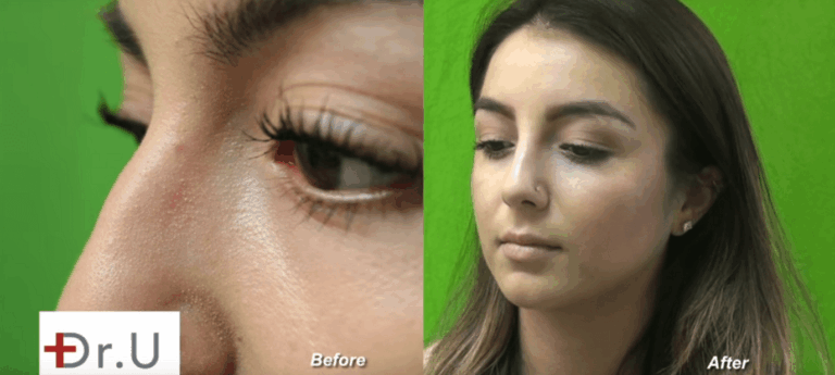 The question of how often should you get fillers may depend on how mobile the treatment area is