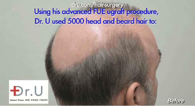 No growth after hair transplant surgery results from the poor handling of grafts which hurts their chances of survival