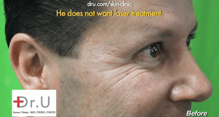 Patient before using Belotero filler for crows feet wrinkles*